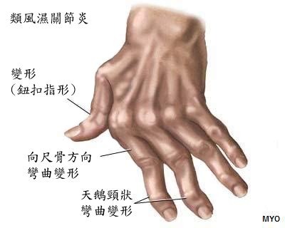 風濕病|類風濕性關節炎 健康主題 (Rheumatoid Arthritis) 